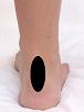 Pain pattern for Achillodynia Tendinitis of Achilles' tendon