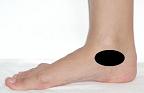 Pain pattern for Tarsal Tunnel Syndrome